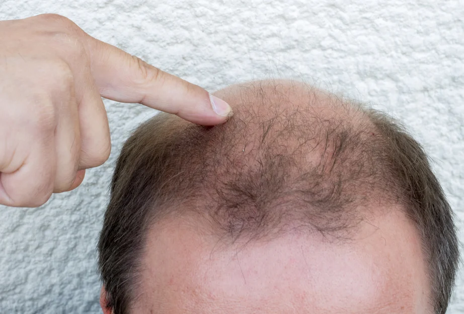 Da Vinci Hair Loss